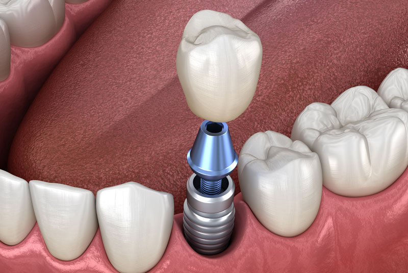 dental implant model