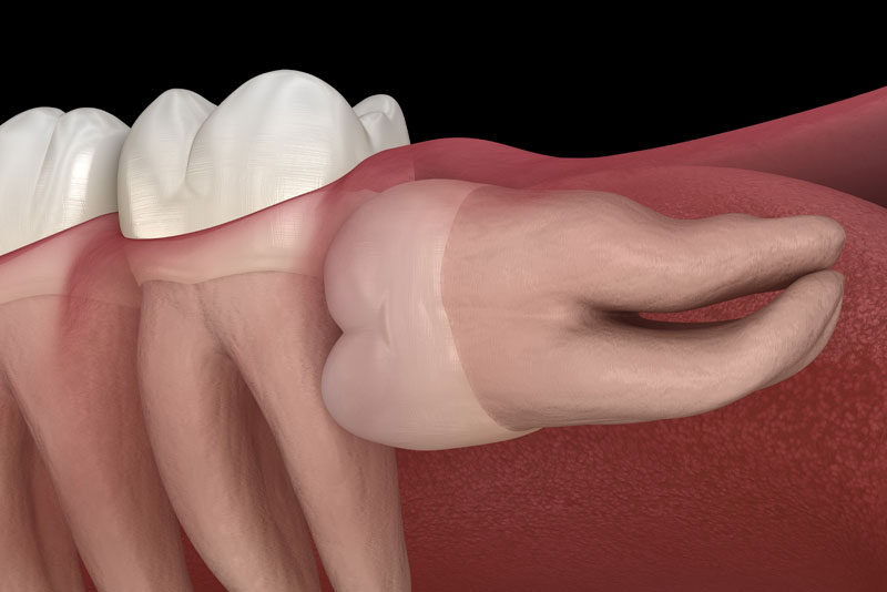 impacted wisdom tooth model