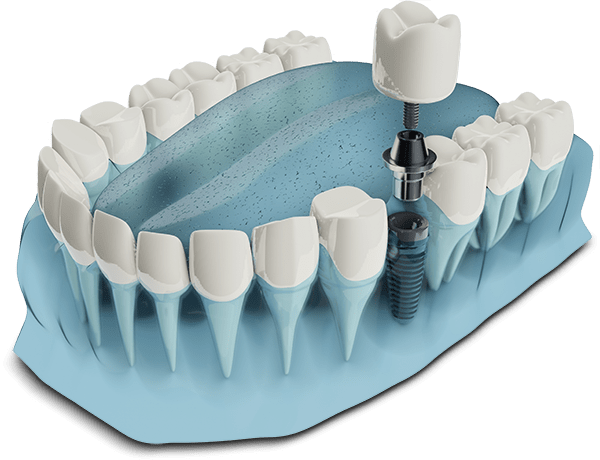 dental implant model