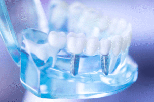 Dental clear jaw model with dental tooth implant.