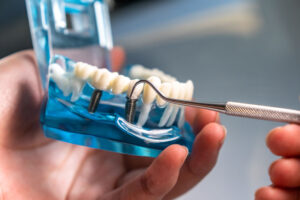 Dive into the essential role that tooth posts play in dental implants. Learn why they're crucial, how they’re placed today.
