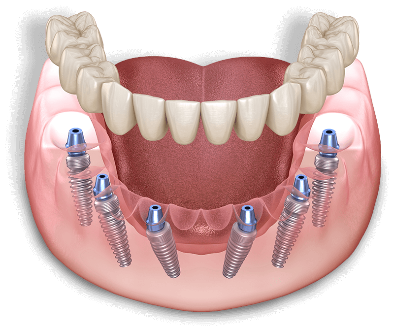 full-arch-dental-implant-model