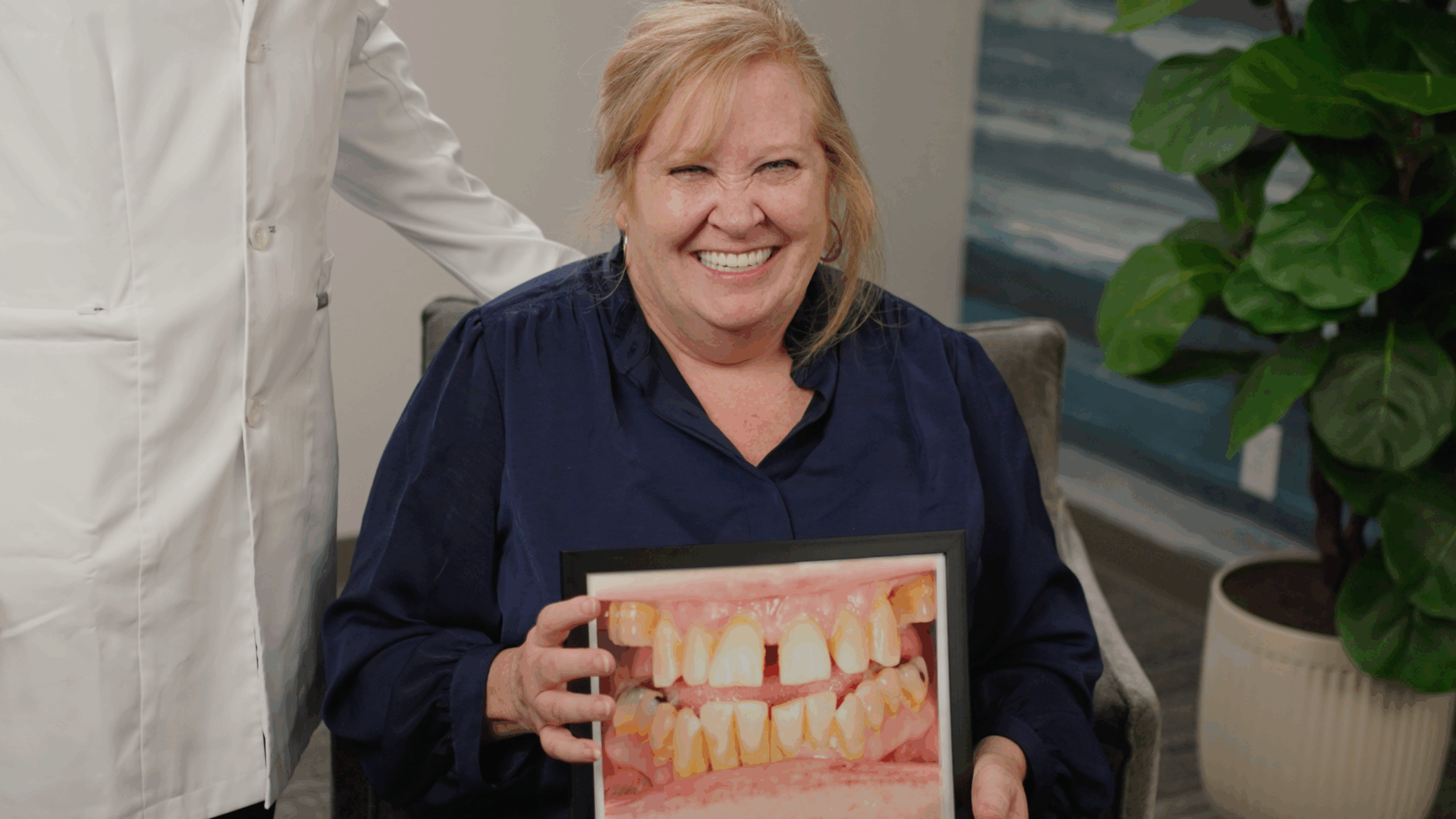 Full Mouth Dental Implants before and after photo of a female