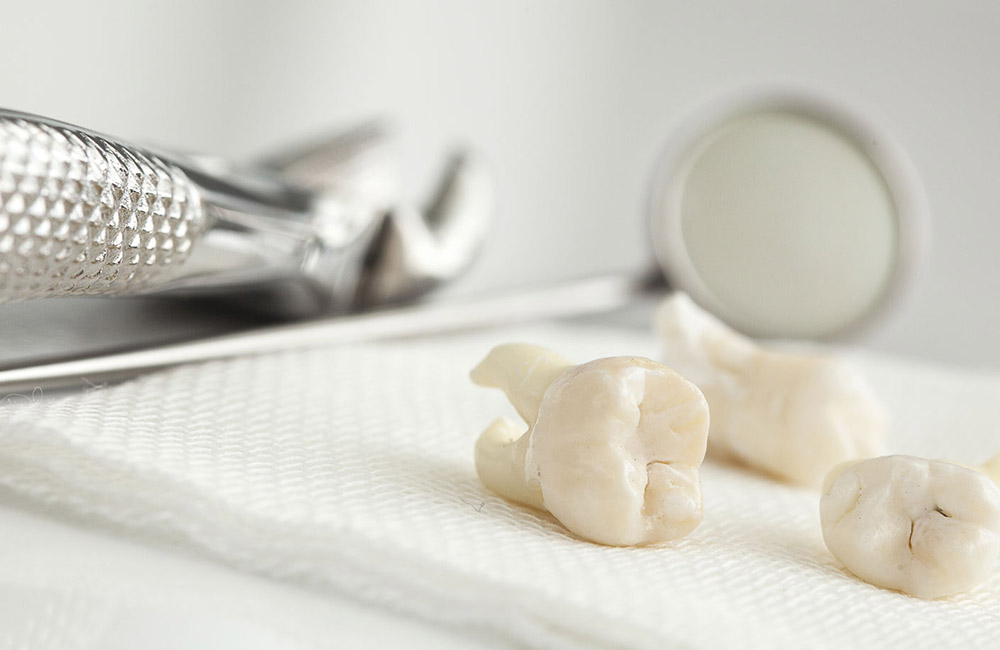 tooth extractions
