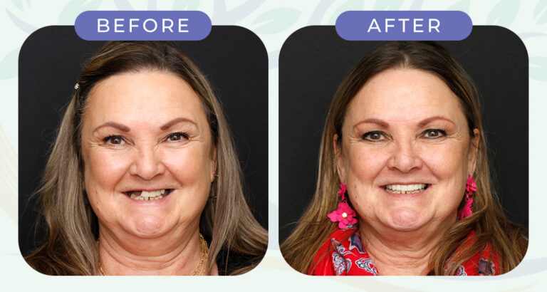 A side‑by‑side before‑and‑after photo of the same middle‑aged person smiling against a dark background. In the before image, the person has multiple missing upper teeth and visible gaps. In the after image, the person shows a complete, even, natural‑looking smile restored with full mouth dental implants, along with different clothing and accessories.