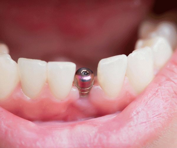 close up shot of a patient’s mouth with a single implant.