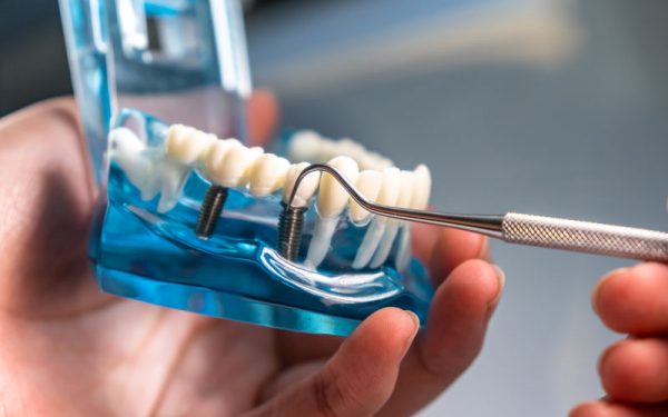 Dive into the essential role that tooth posts play in dental implants. Learn why they're crucial, how they’re placed today.