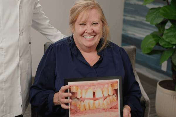 Full Mouth Dental Implants before and after photo of a female