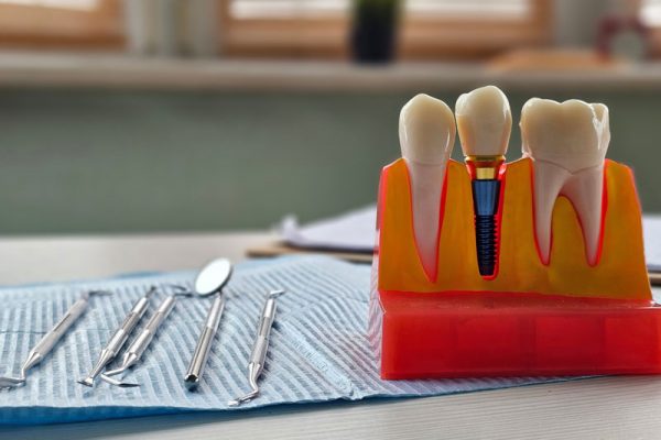 Dental implant, artificial tooth roots into jaw, root canal of dental treatment, gum disease, teeth model for dentist.