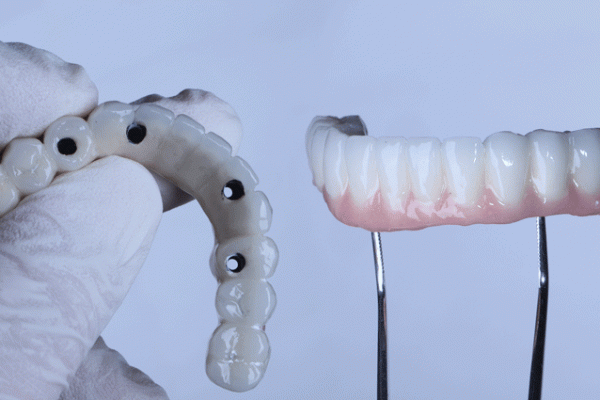 Full arch porcelain dental prosthesis on only 4 implants for completely edentulous jaws in dental jaw surgery and dentistry.