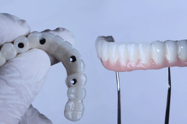 Full-arch-porcelain-dental-prosthesis