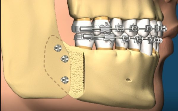 class ll skeletal surgical correction image