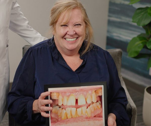 full-arch-dental-implants