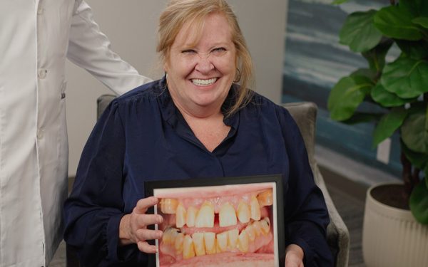 full-arch-dental-implants