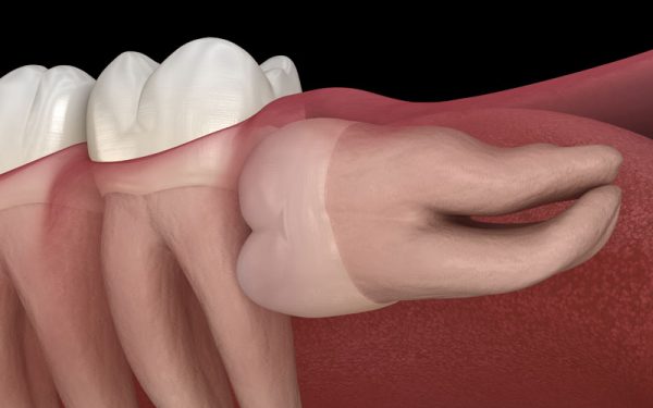 impacted wisdom tooth model