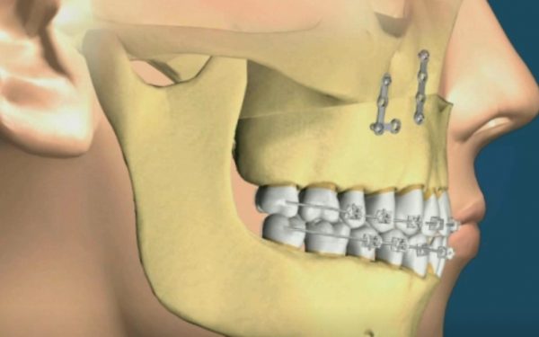 maillary excess reduction side view